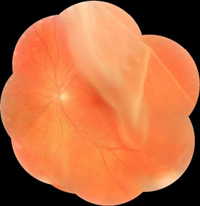 Imagem ilustrativa de um descolamento de retina causado por grande ruptura superior