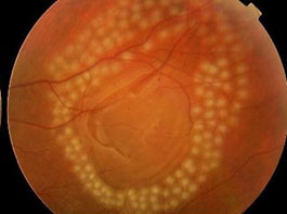 Imagem ilustrativa de uma retina tratada com fotocoagulação a laser