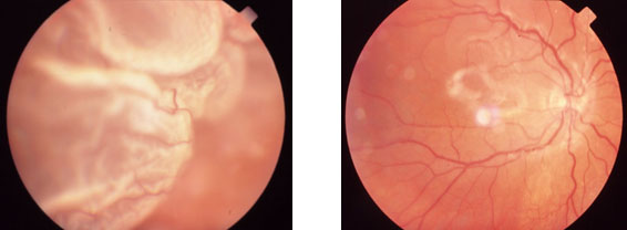 Imagem ilustrativa de descolamento de retina antes e depois da cirurgia