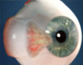 Figura ilustrativa de um globo ocular com episclerites