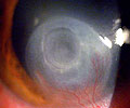 Imagem ilustrativa de uma úlcera de córnea