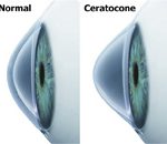 Figura ilustrativa de um olho normal e um com ceratocone