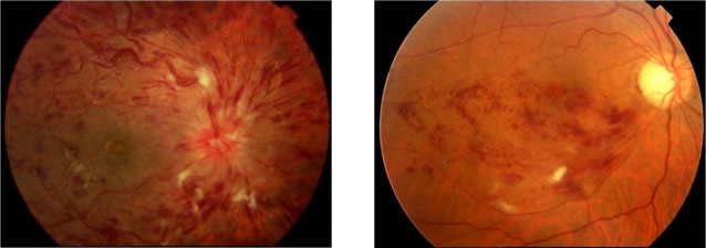 Imagem ilustrativa de uma retica com oclusão de veia central da retina e de oclusão de ramo venoso retiniano temporal inferior