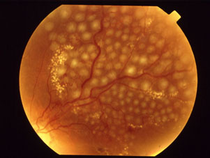 Imagem ilustrativa de obstrução de ramo venoso retiniano tratada com fotocoagulação a laser
