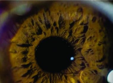Terapia Antiangiogênica é aliada em tratamentos oculares