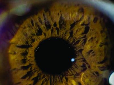 Terapia Antiangiogênica é aliada em tratamentos oculares