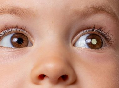 Especialistas explicam o retinoblastoma, câncer que acomete os olhos de crianças