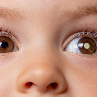 Especialistas explicam o retinoblastoma, câncer que acomete os olhos de crianças